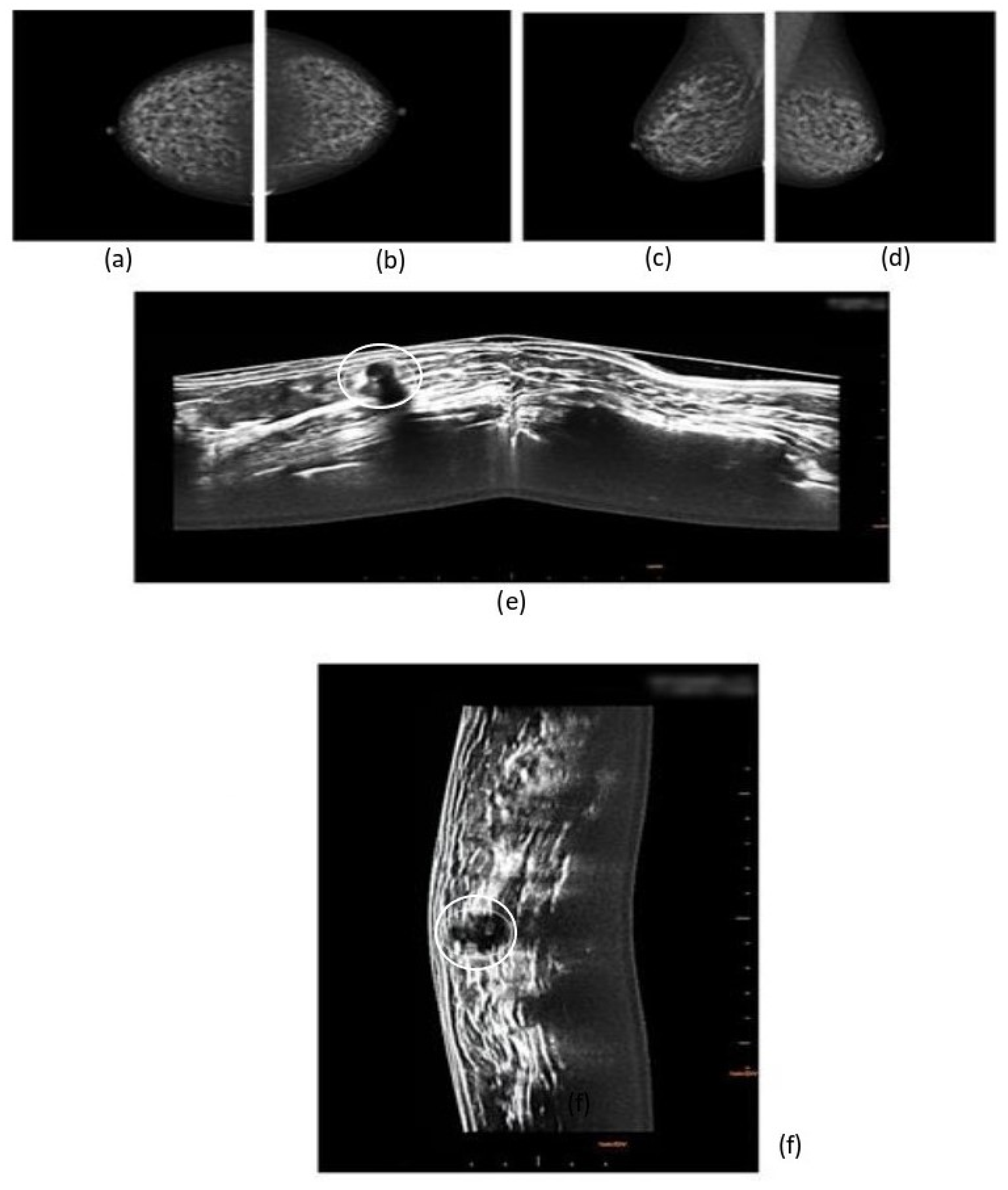 Jpm Free Full Text Second Generation 3d Automated Breast Ultrasonography Prone Abus For