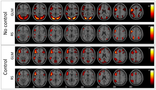 JPM | Free Full-Text | Preoperative Assessment of Language Dominance ...