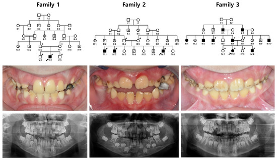 Novel KLK4 Mutations Cause Hypomaturation Amelogenesis Imperfecta Novel KLK4 Mutations Cause Hypomaturation Amelogenesis Imperfecta