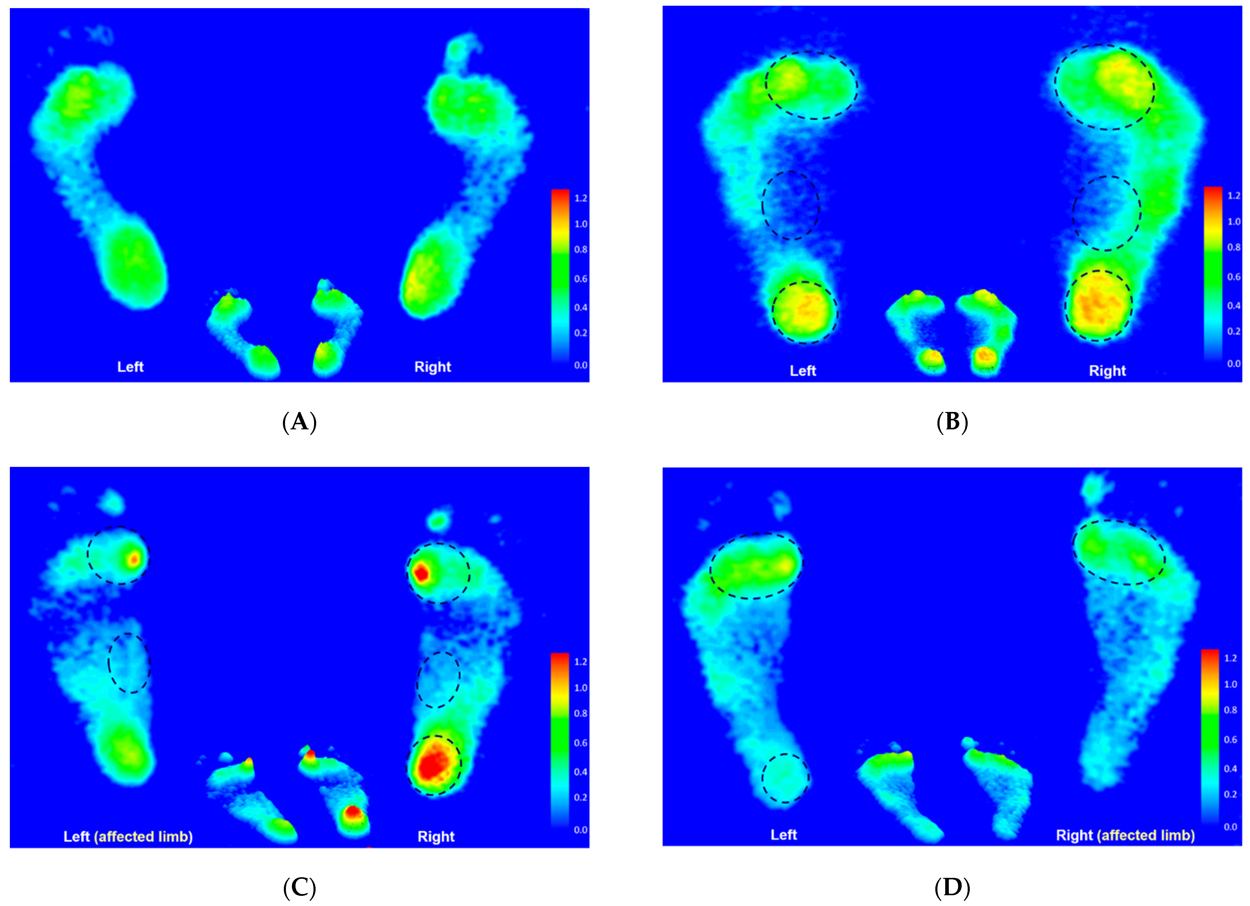 JPM | Free Full-Text | Traceable Features of Static Plantar Pressure ...