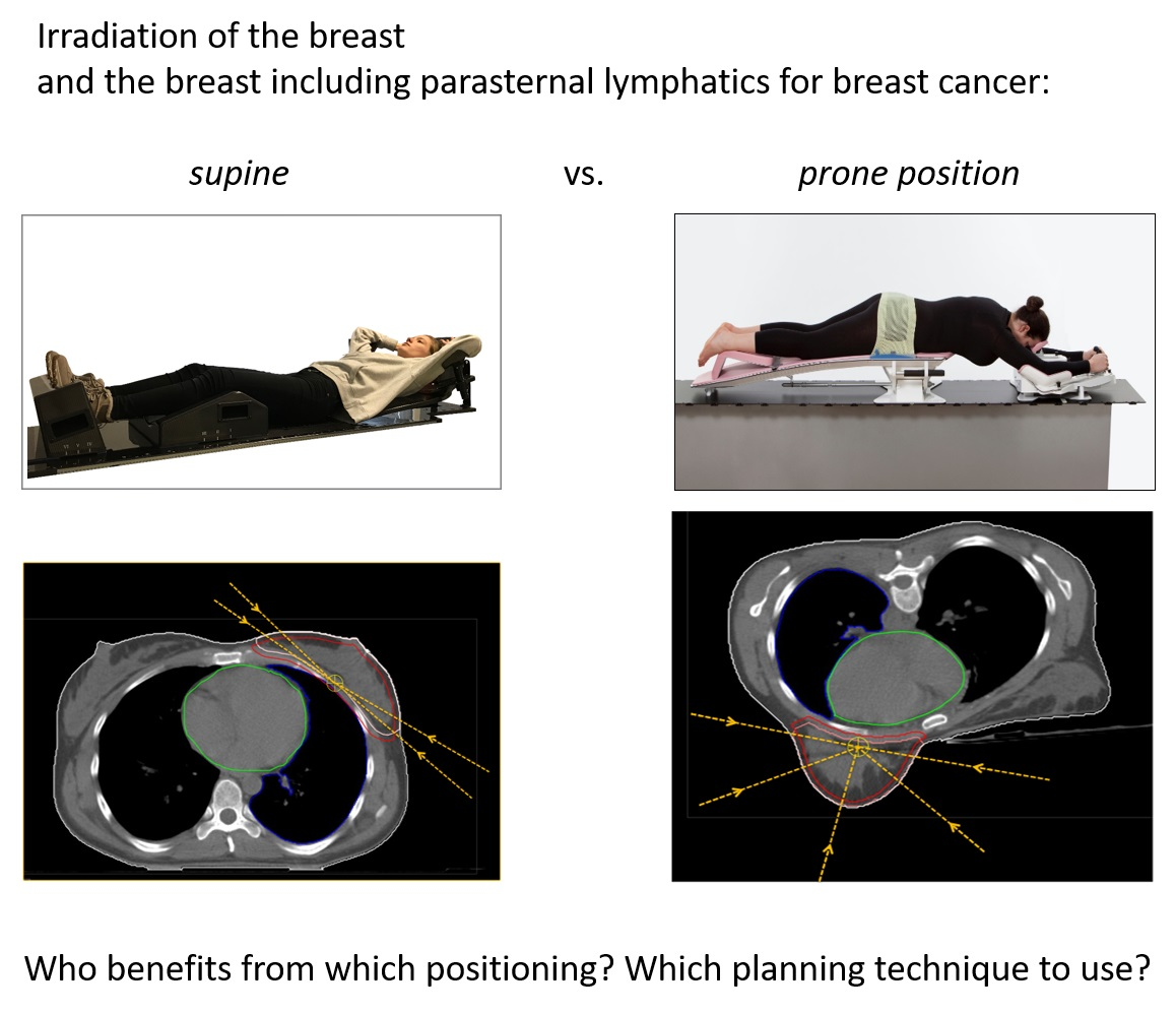 External-beam partial breast irradiation in a supine versus prone position  after breast-conserving surgery for Chinese breast cancer patients