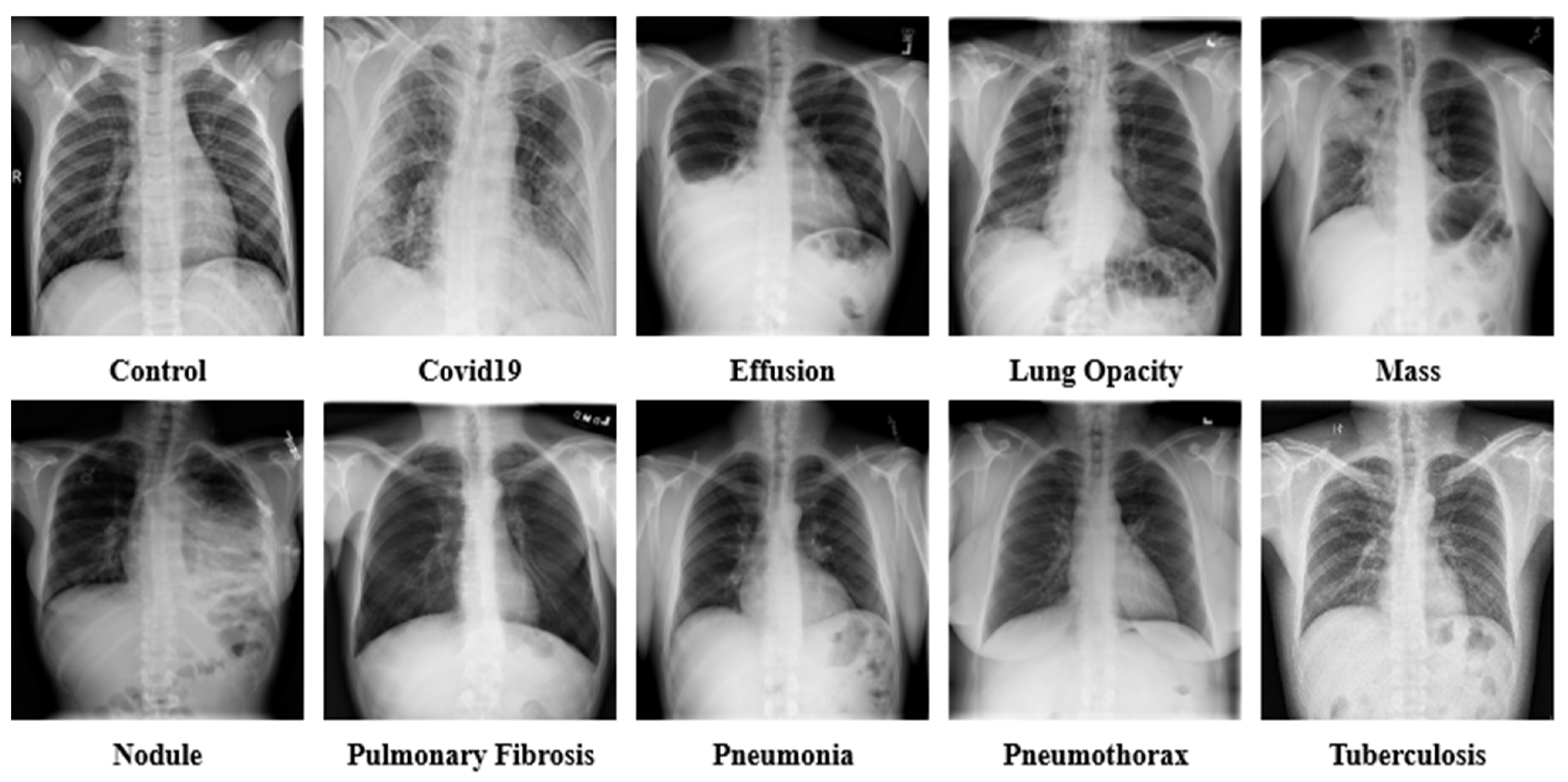Pulmonary Fibrosis Xray Pulmonary Fibrosis Xray