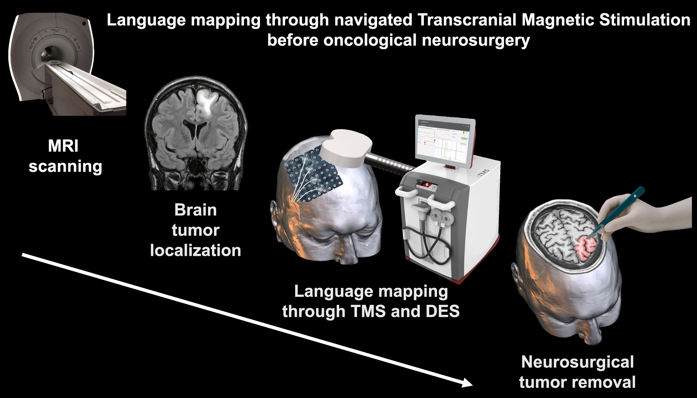 JPM Free Full-Text Preoperative Navigated Transcranial Magnetic  Stimulation: New Insight for Brain Tumor-Related Language Mapping