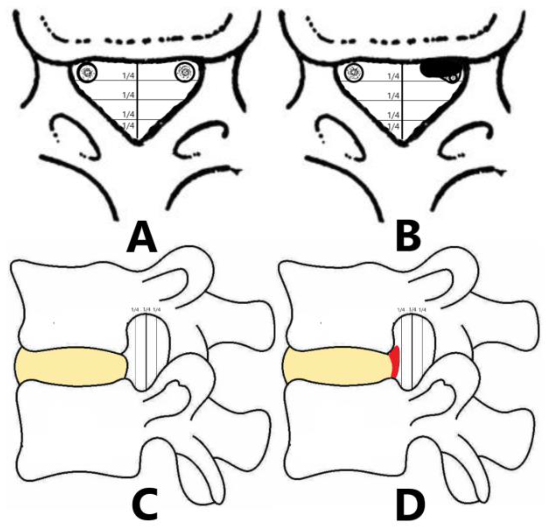 JPM Free Full-Text Clinical Characteristics of Minimal Lumbar Disc Herniation and Efficacy of Percutaneous Endoscopic Lumbar Discectomy via Transforaminal Approach A Retrospective Study photo