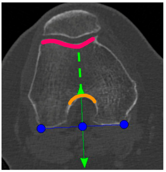 Traction Internal Rotation View Setting the Tibial Component Rotation Based on Femoral Landmarks Allows ...