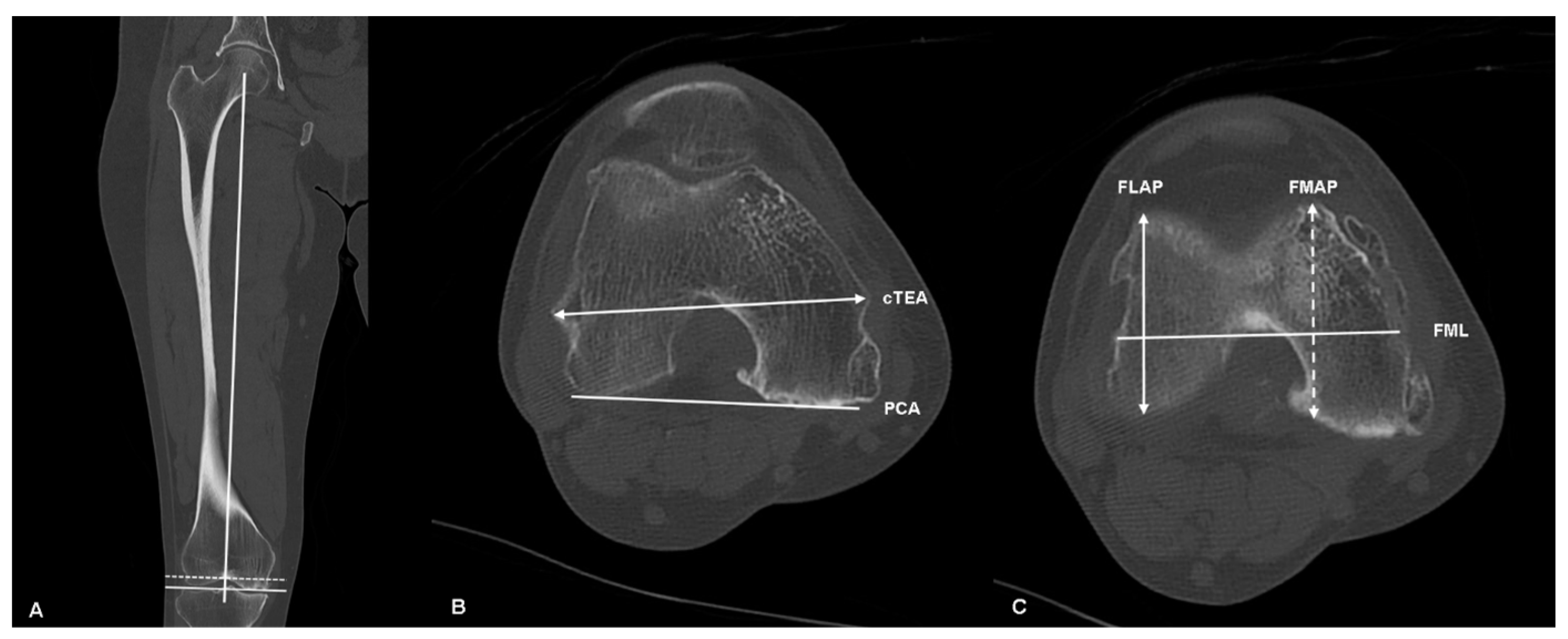 Anatomical Reference of the Femur after Distal Resection Is Reliable ...