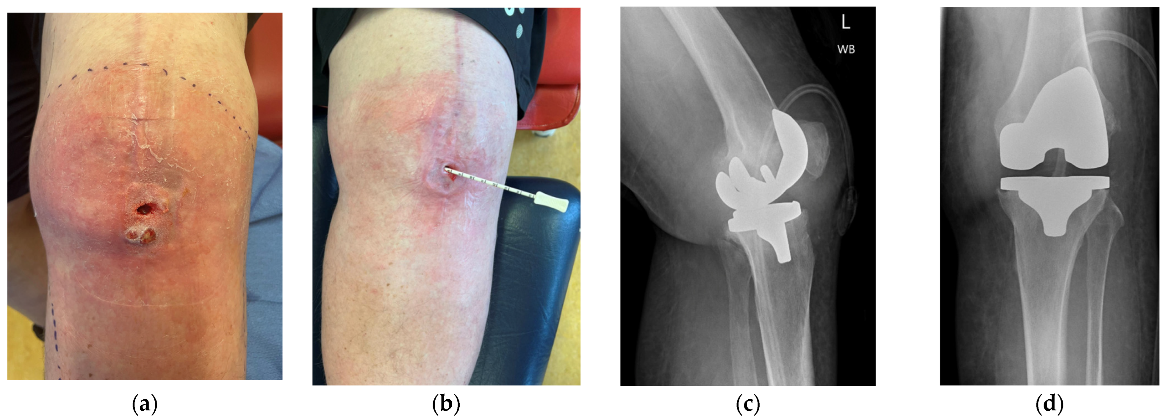 Jpoint Inflection Management of Complex Peri-Prosthetic Joint Infection Following Total ...