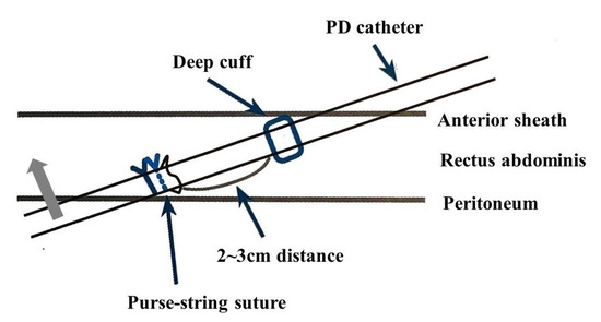 The Figure 8 Double Purse-String Suture | Anesthesia Key