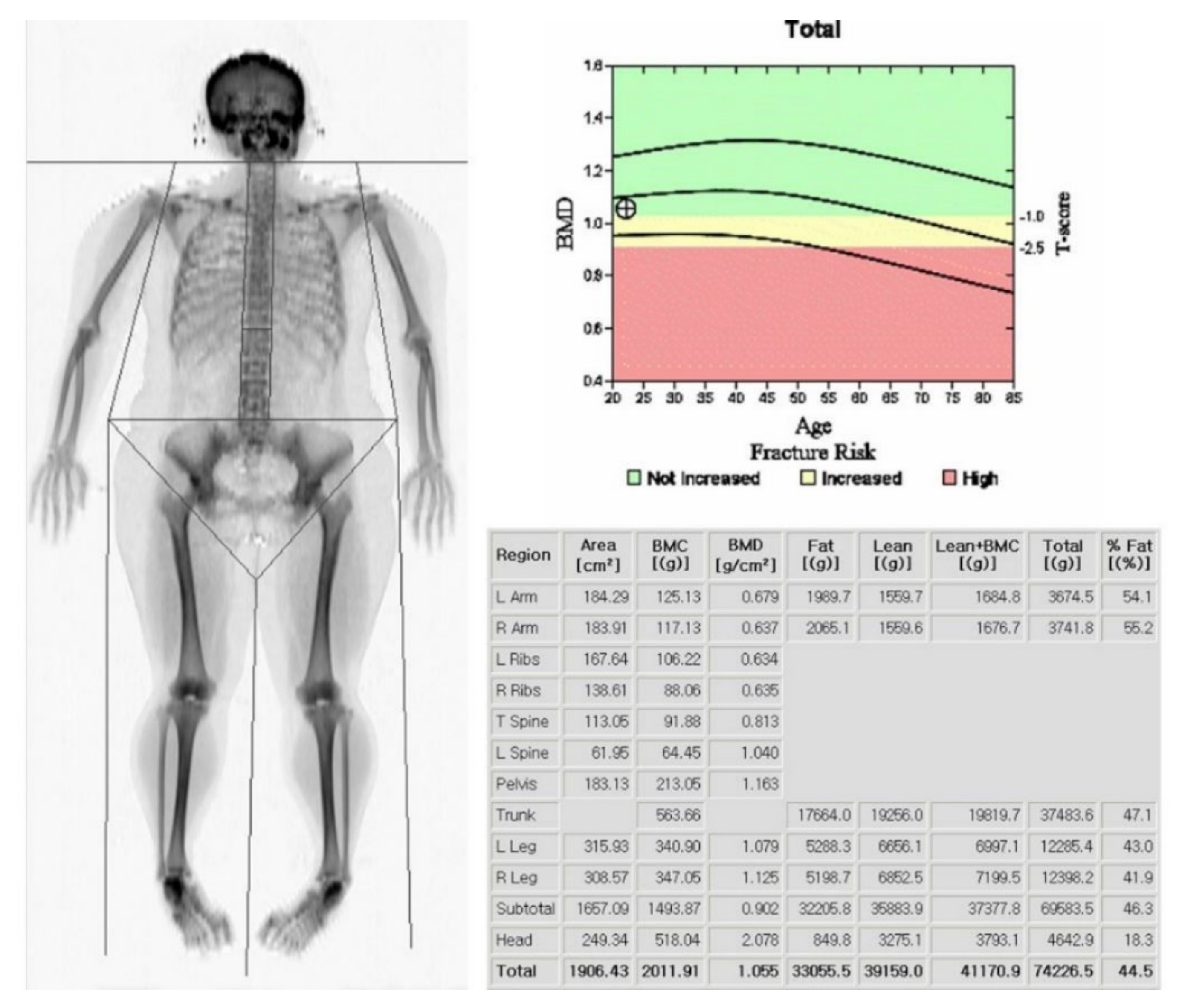 What do the numbers on a DEXA scan actually mean? - Active Seniors