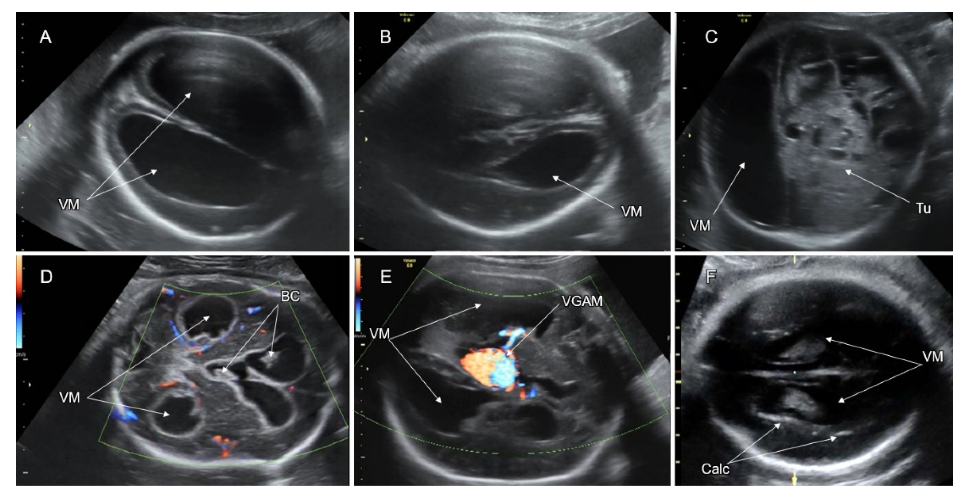 ventriculomegaly ultrasound