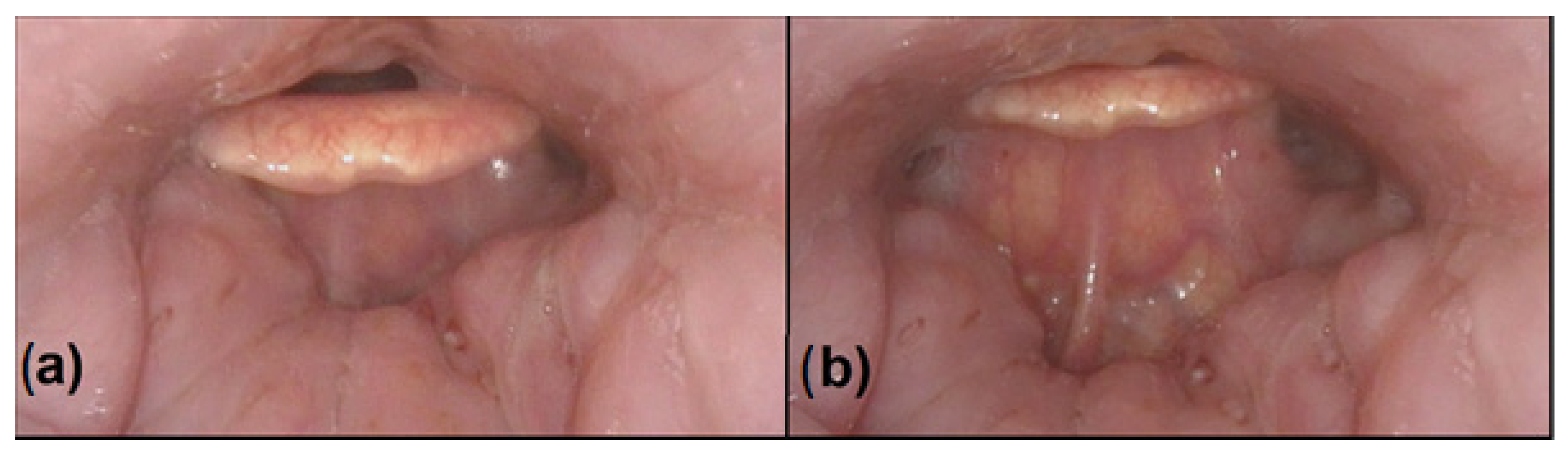 Tonsil Tongue Out Porn - Life | Free Full-Text | Epiglottopexy Is a Treatment of Choice for  Obstructive Sleep Apnea Caused by a Collapsing Epiglottis