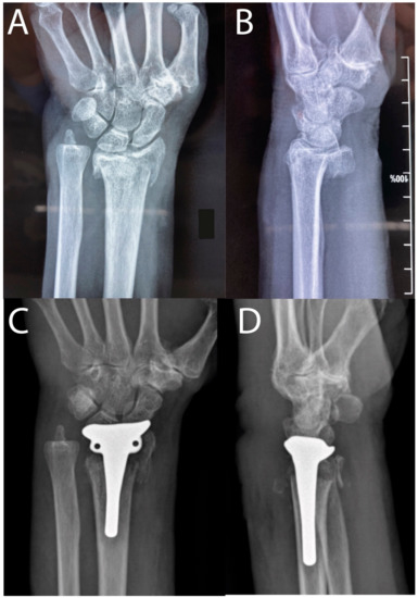 Wrist Hemiarthroplasty of Irreparable Distal Radius Fracture under