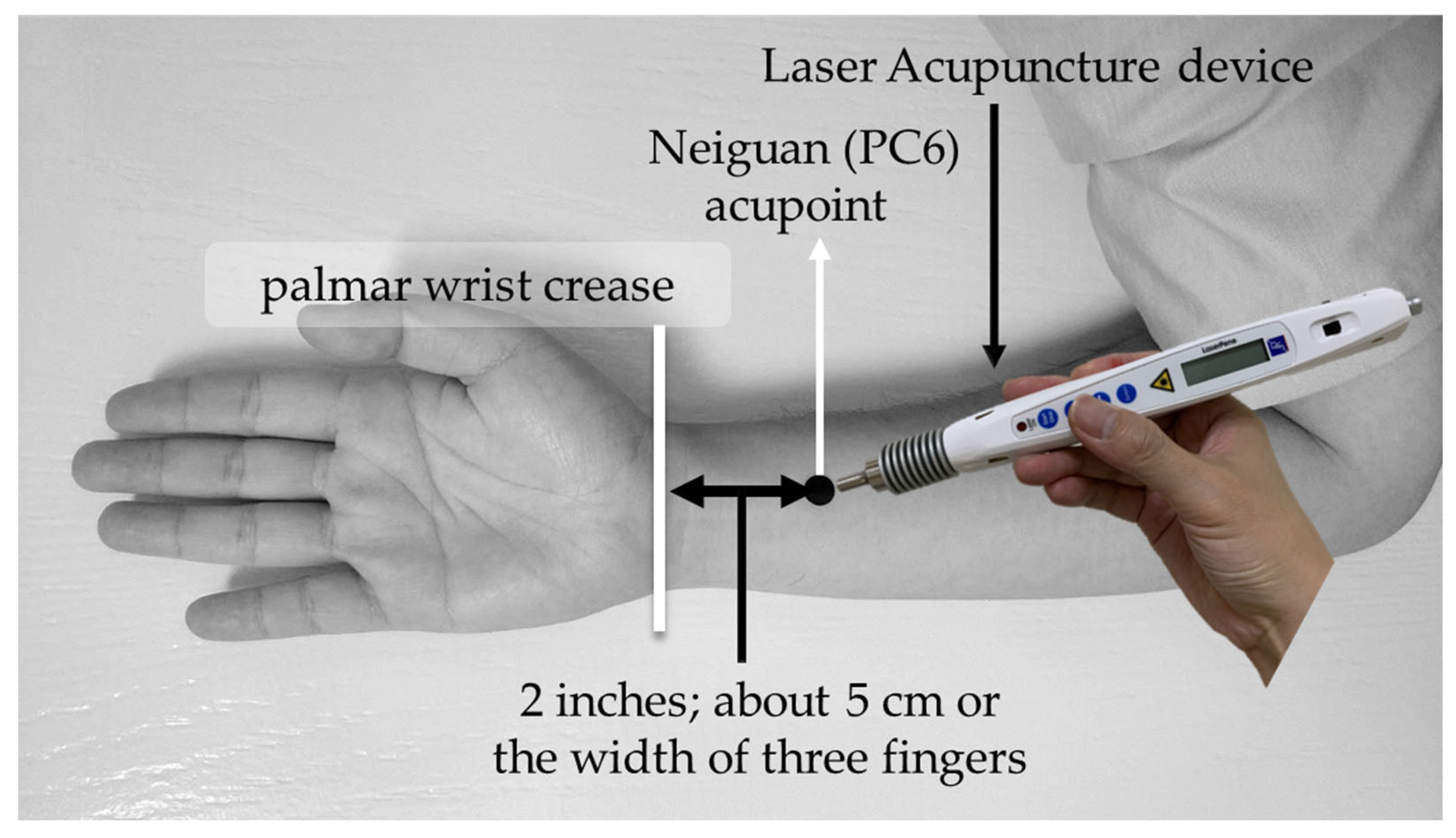 The electrical acupuncture stimulator used in the study (paper I).