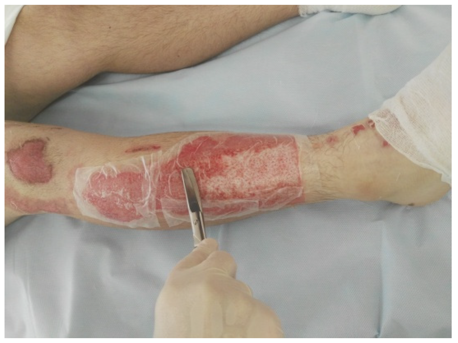 Effect of Ec.Me treatment in excision and burn wound-healing