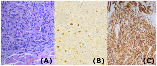 Life | Free Full-Text | Embryonal Rhabdomyosarcoma of the Tongue in Adults