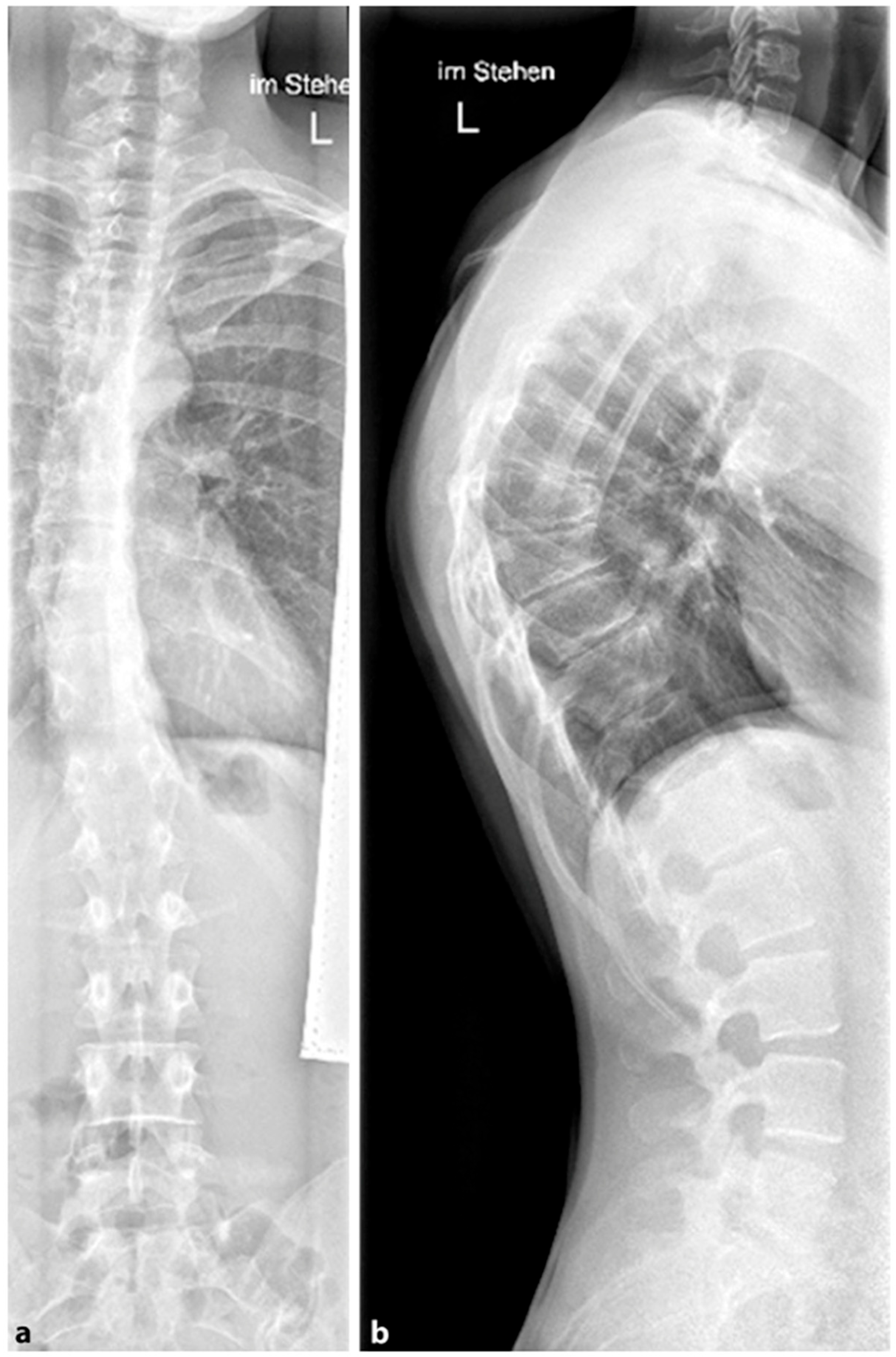 Lumbar Spinal Bracing, Non-Surgical Scheuermann's Kyphosis