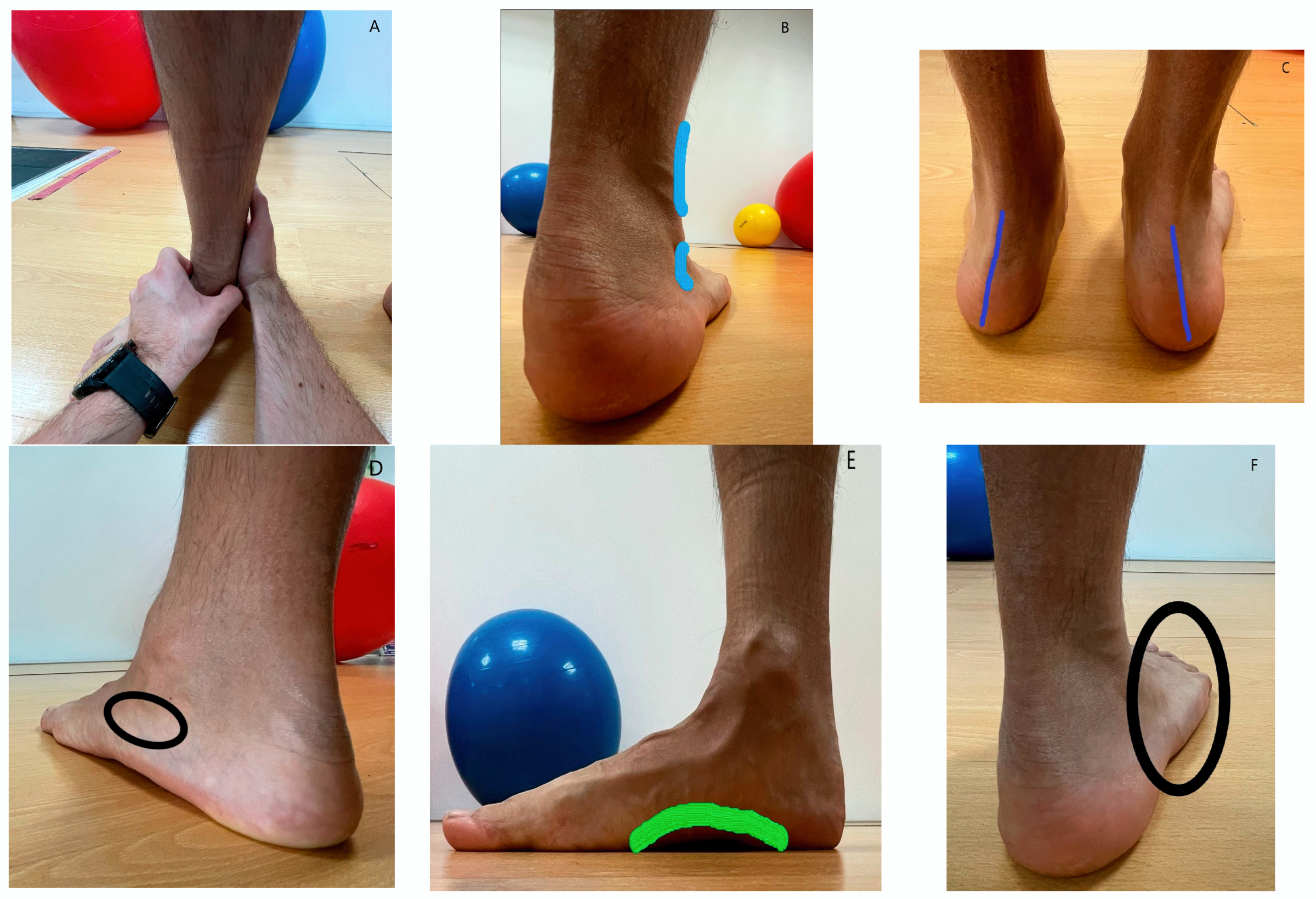 Calf Injuries in Adult Soccer Players, Weston