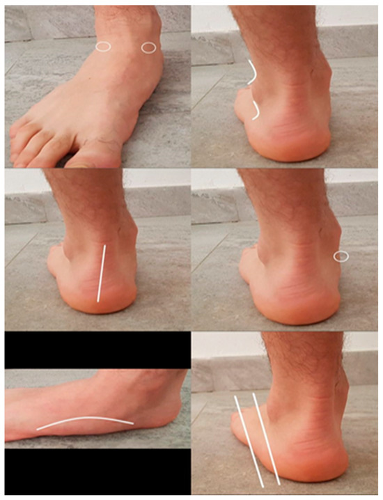 15 Best Exercise to relieve Heel Pain - Samarpan Physio