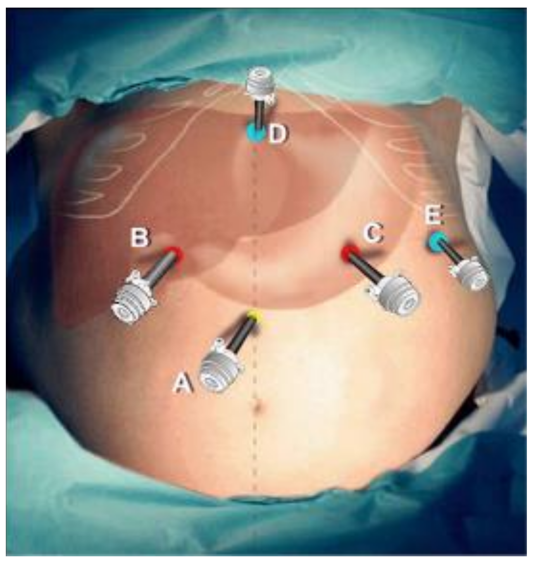 First port placement - Port placement in minimally invasive surgery -  Laparoscopic surgery steps 
