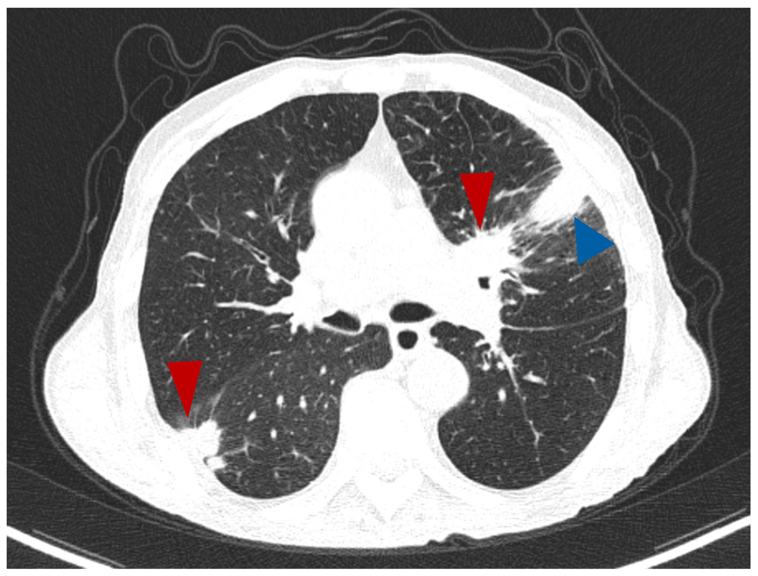 Lung Ct Scan Results Lung Cancer Ct Scan Symptoms GTUBM Lung Ct Scan Results Lung Cancer Ct Scan Symptoms GTUBM