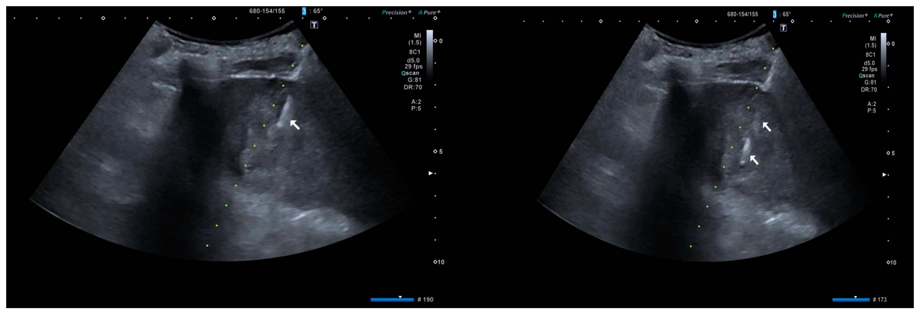 A Case of a Neuroendocrine Tumor in a Liver Transplant Patient ...