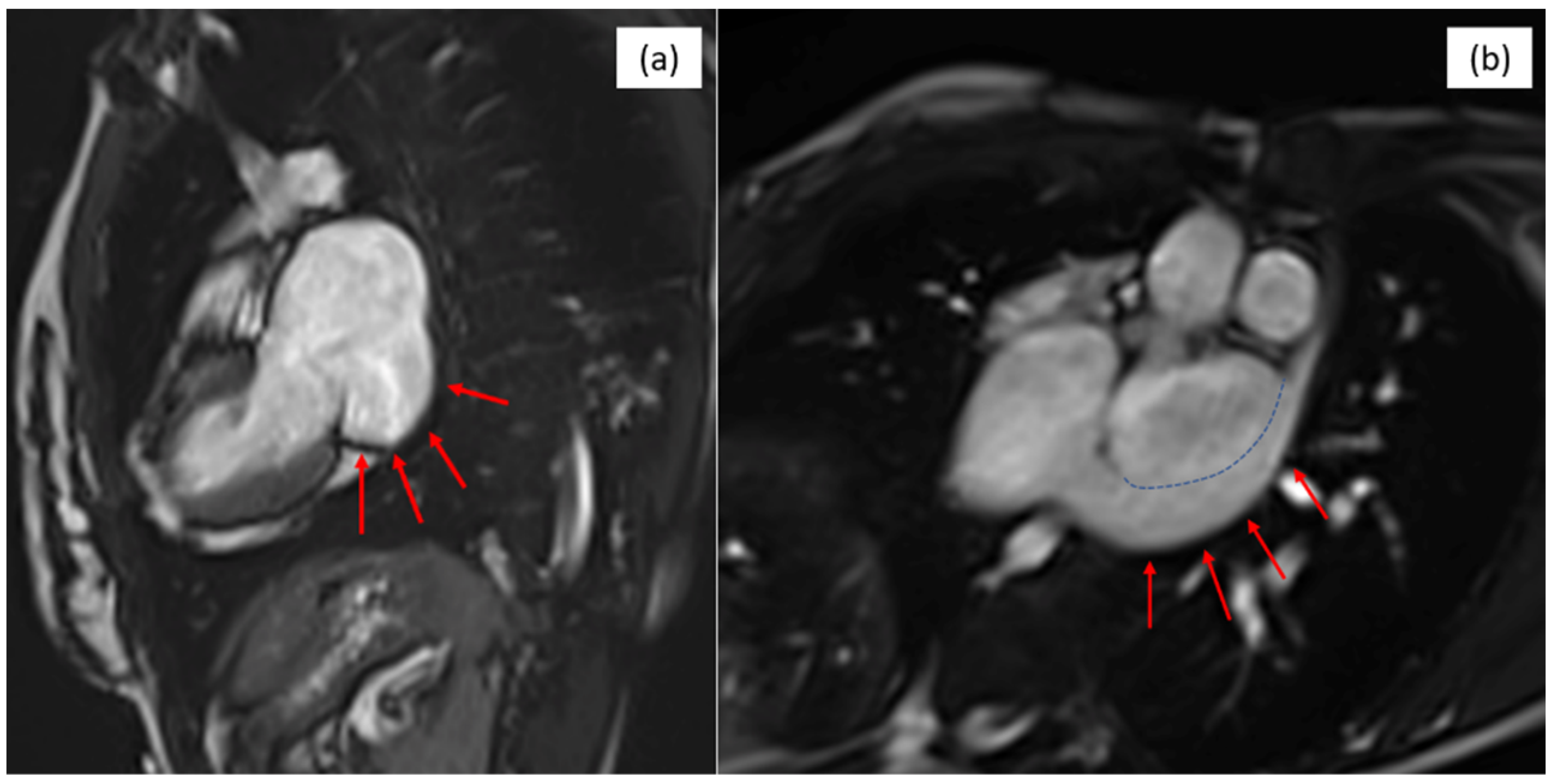 Late Diagnosis of Unroofed Coronary Sinus Associated with Persistent ...