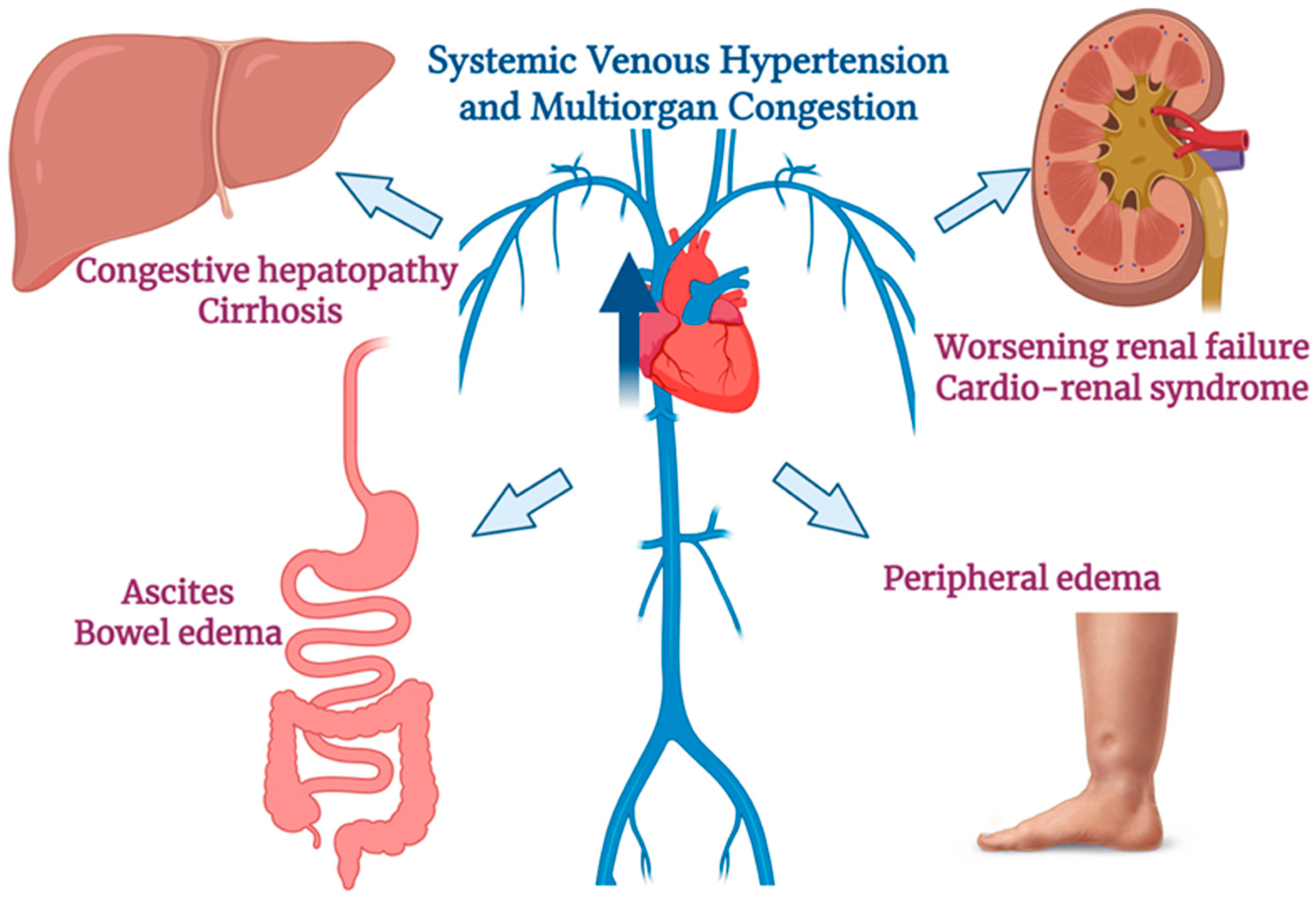 Assessment of Congestion in Heart Failure Using VExUS: Current Evidence ...