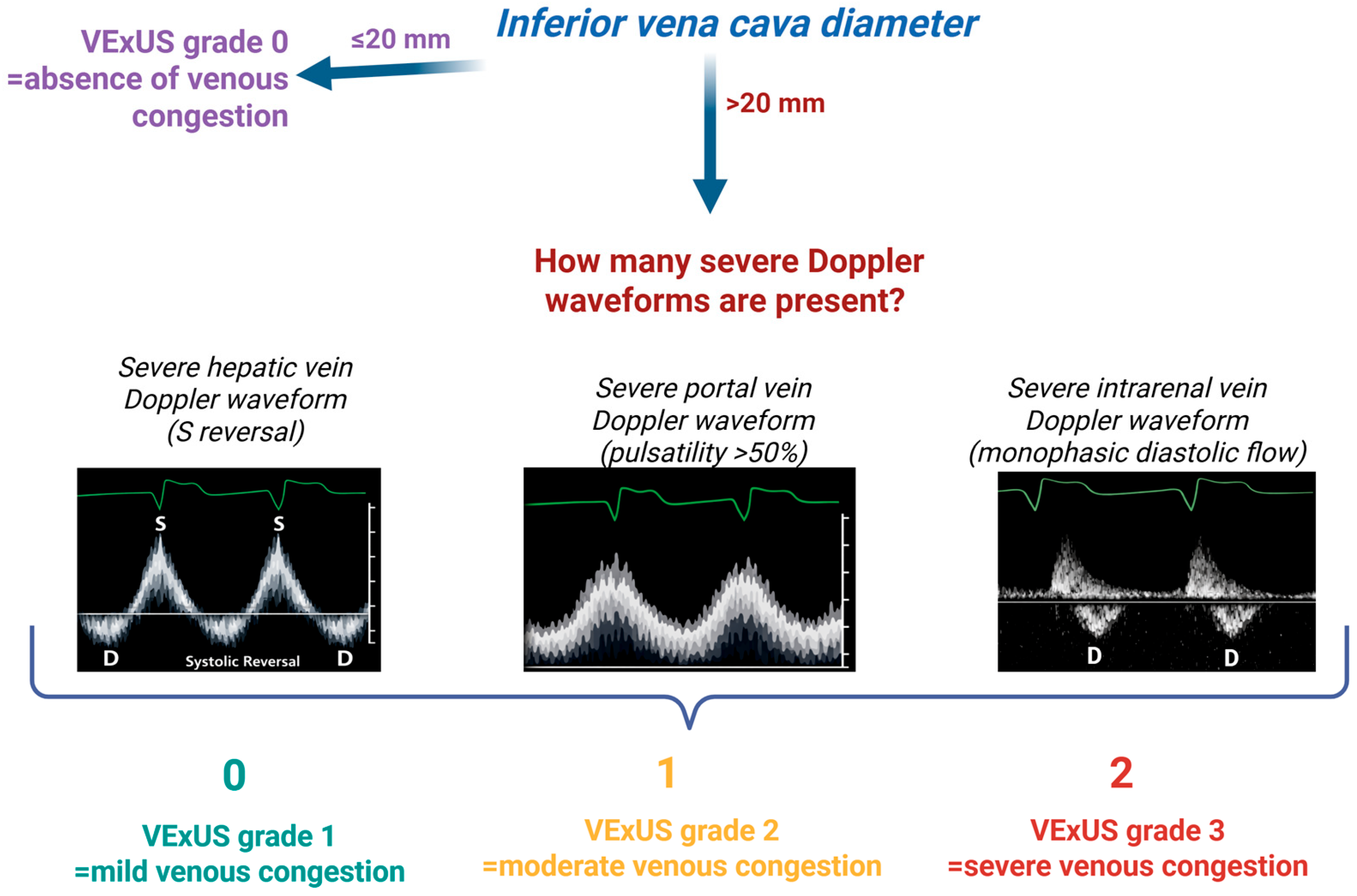 Assessment of Congestion in Heart Failure Using VExUS: Current Evidence ...