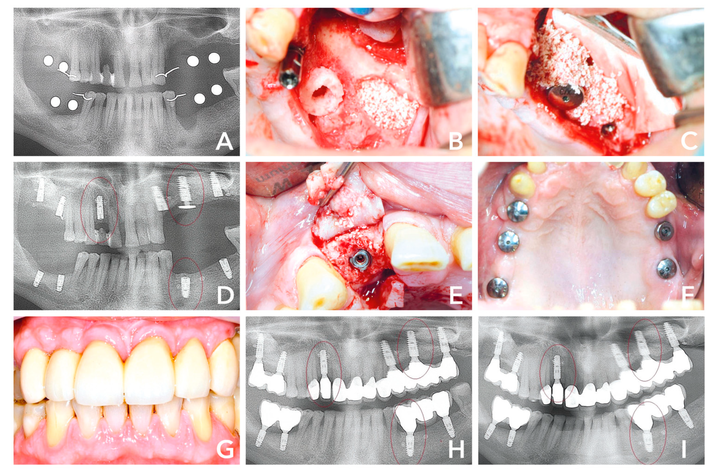 PDF) Bone ring autogenous graft transplantationing one stage technique and  early ımplant placement