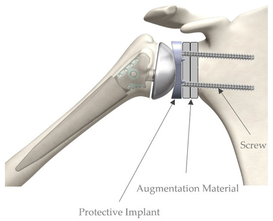 Materials | Free Full-Text | Temporary Protective Shoulder Implants for ...