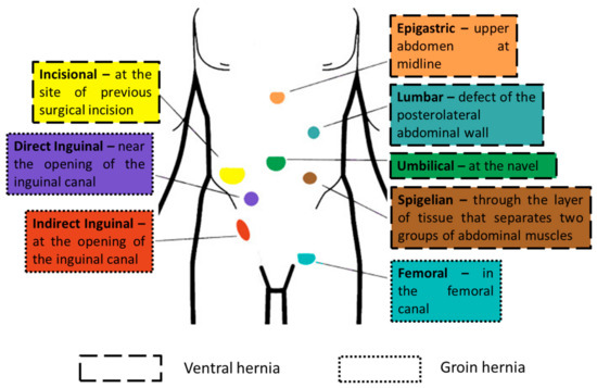 Open femoral hernia repair: one skin incision for all, World Journal of  Emergency Surgery