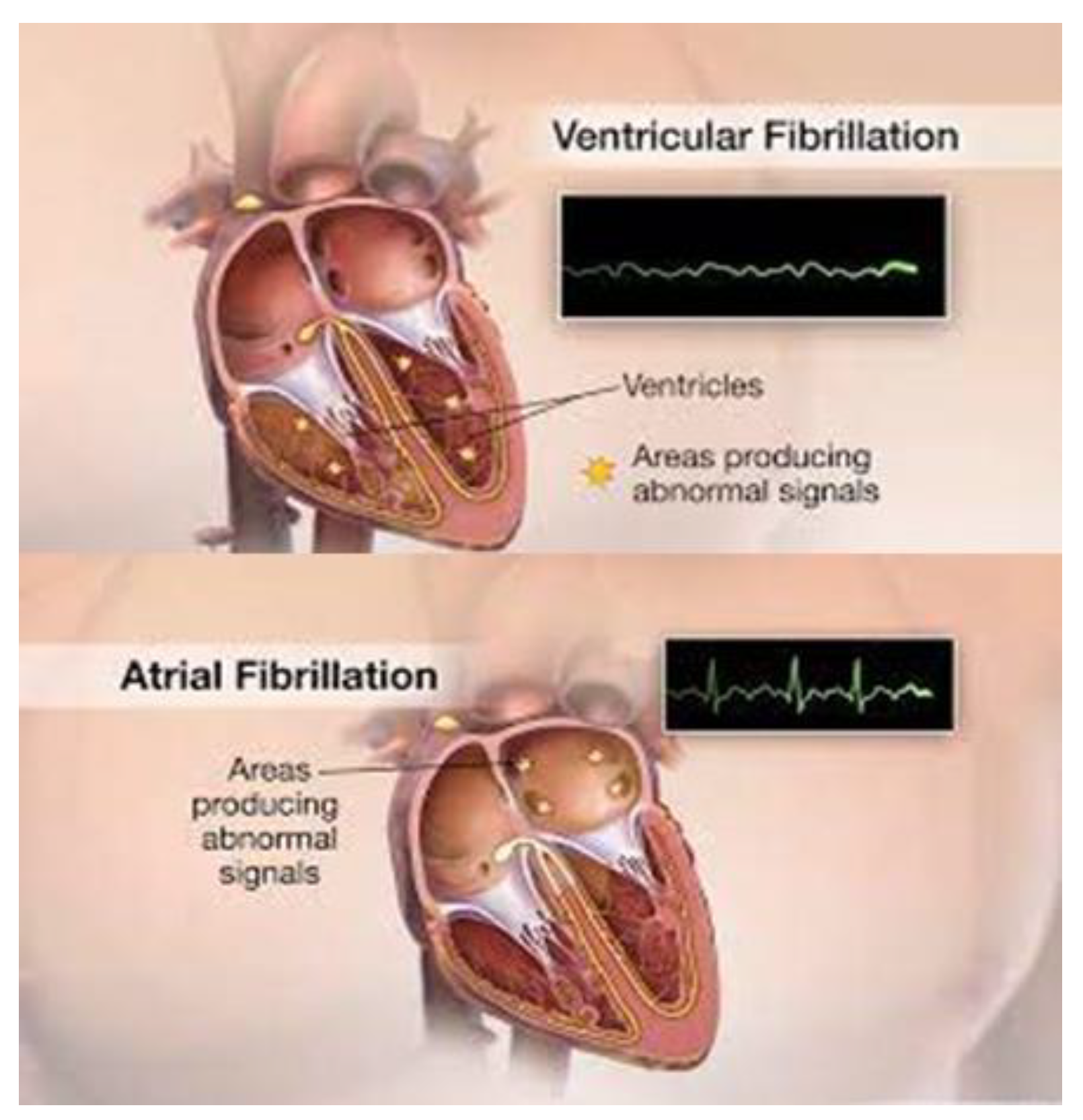 Ventricular Fibrillation Heart Ventricular Fibrillation Heart