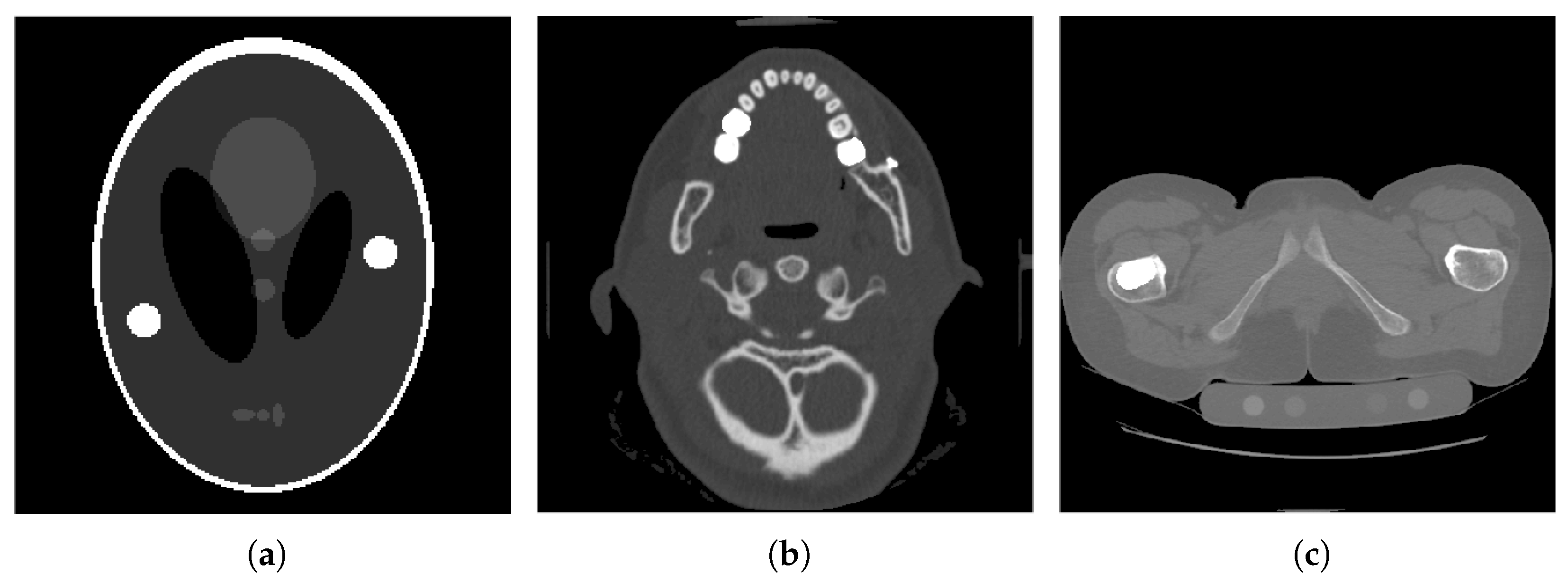 Metal Artifact Reduction in CT Based on a Nonlinear Weighted ...