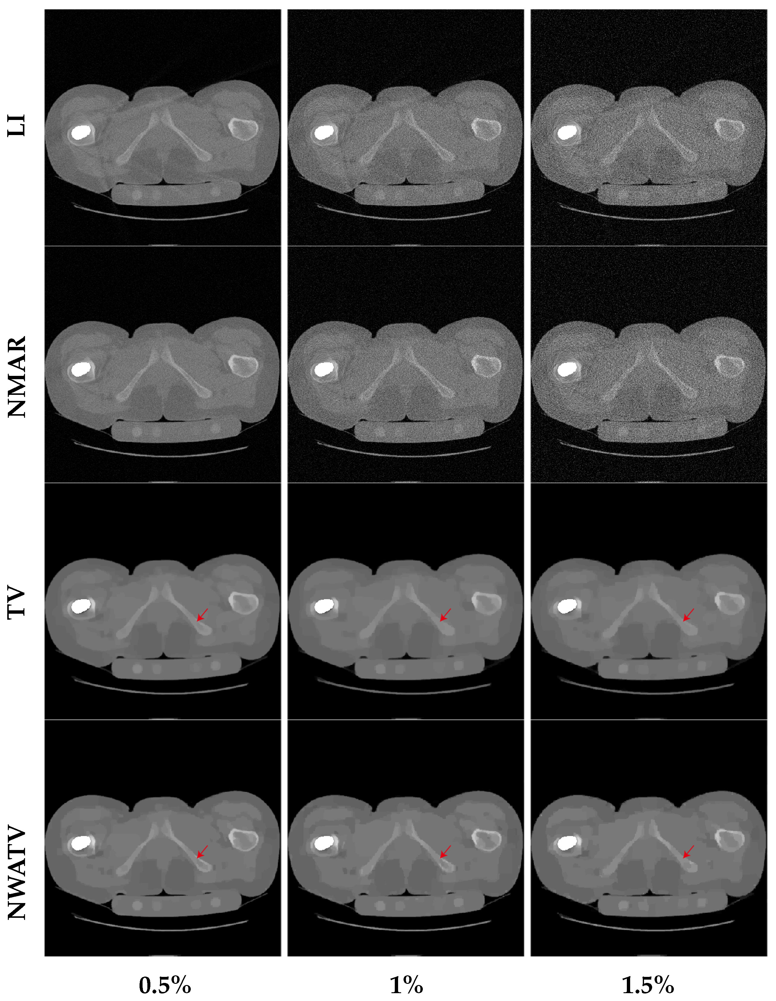Metal Artifact Reduction in CT Based on a Nonlinear Weighted ...