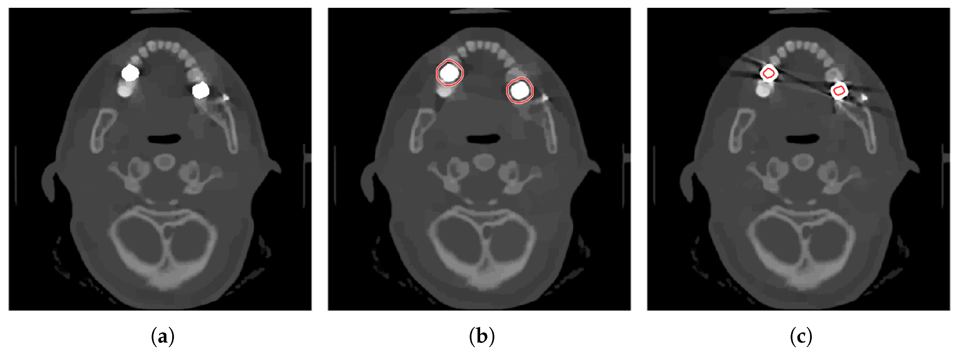 Metal Artifact Reduction in CT Based on a Nonlinear Weighted ...
