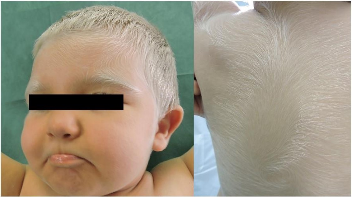 Medicina | Free Full-Text | Congenital Hypopigmentary Disorders with  Multiorgan Impairment: A Case Report and an Overview on Gray Hair Syndromes