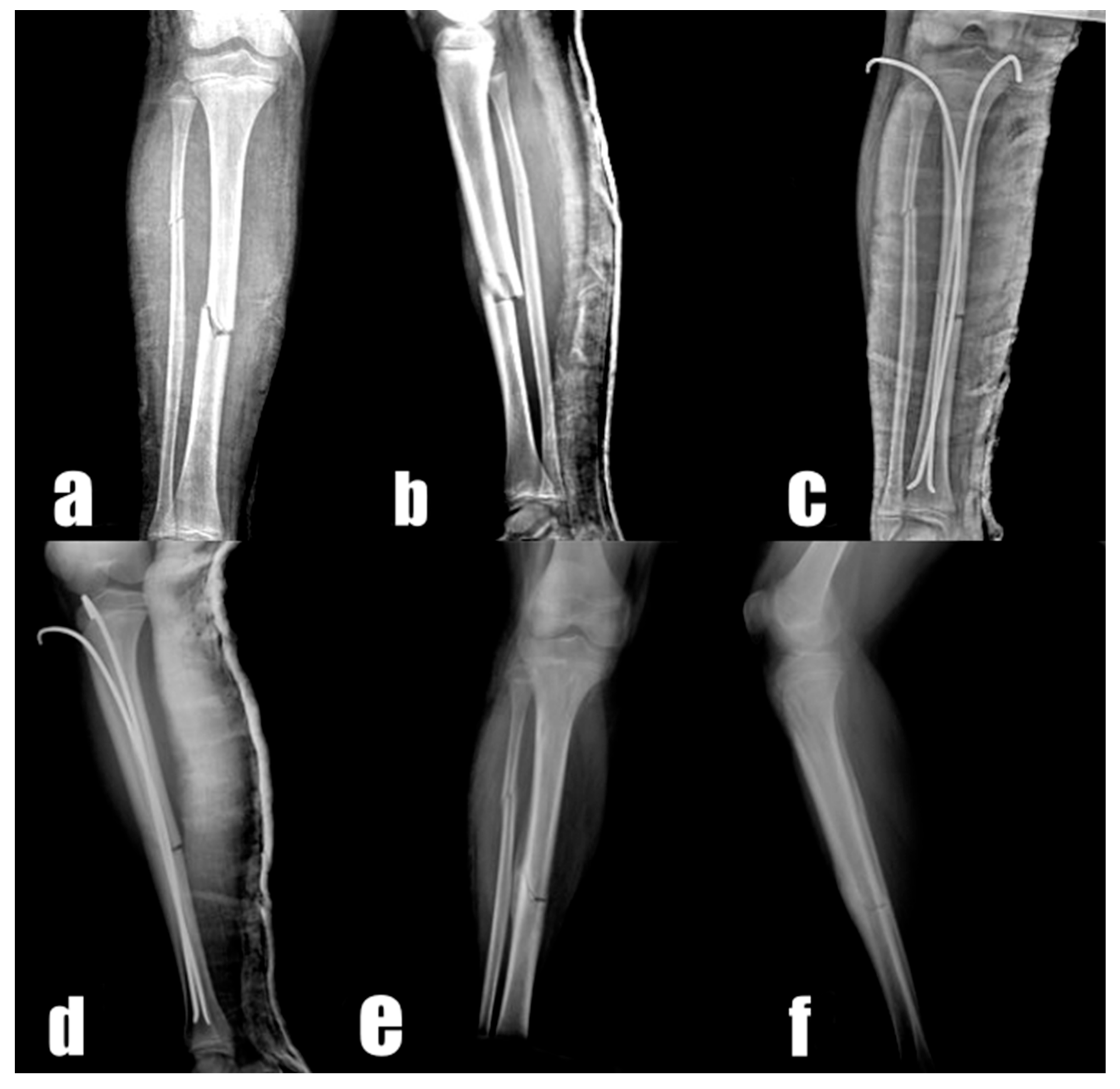 Medicina | Free Full-Text | Treatment of Unstable Pediatric Tibial Shaft  Fractures with Titanium Elastic Nails