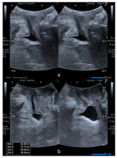 Medicina | Free Full-Text | Transperineal Ultrasound Assessment of a ...