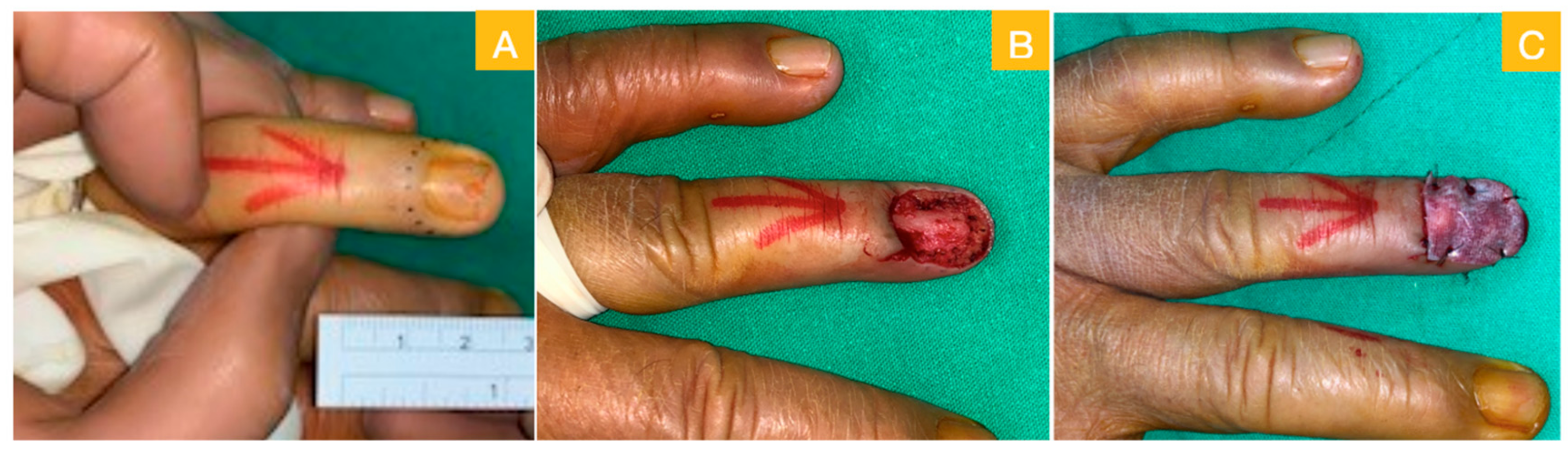 Medicina | Free Full-Text | Reconstruction for Defects of Total Nail Bed  and Germinal Matrix Loss with Acellular Dermal Matrix Coverage and  Subsequently Skin Graft