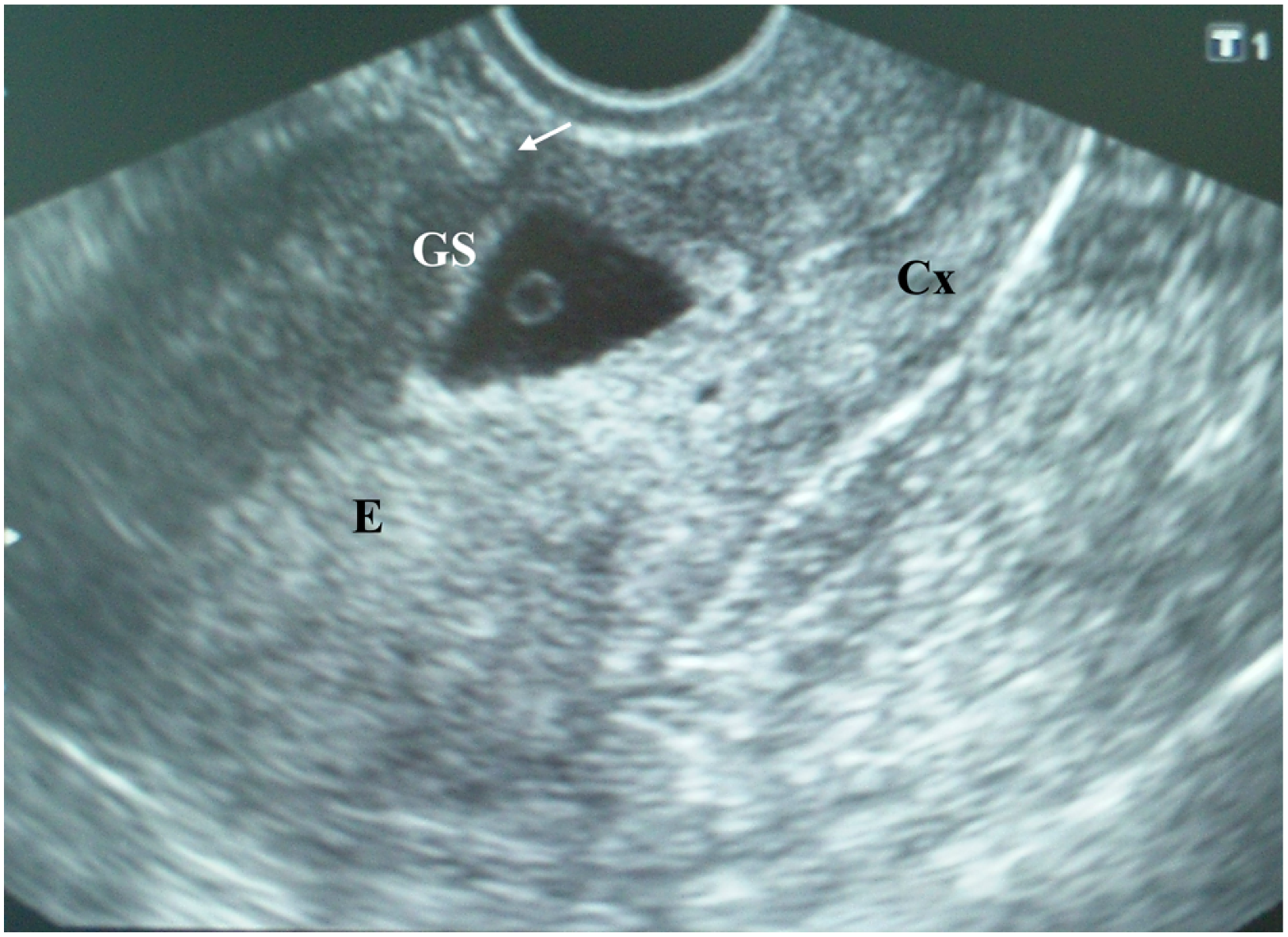 Gestational Sac in Pregnancy and Meaning If Empty