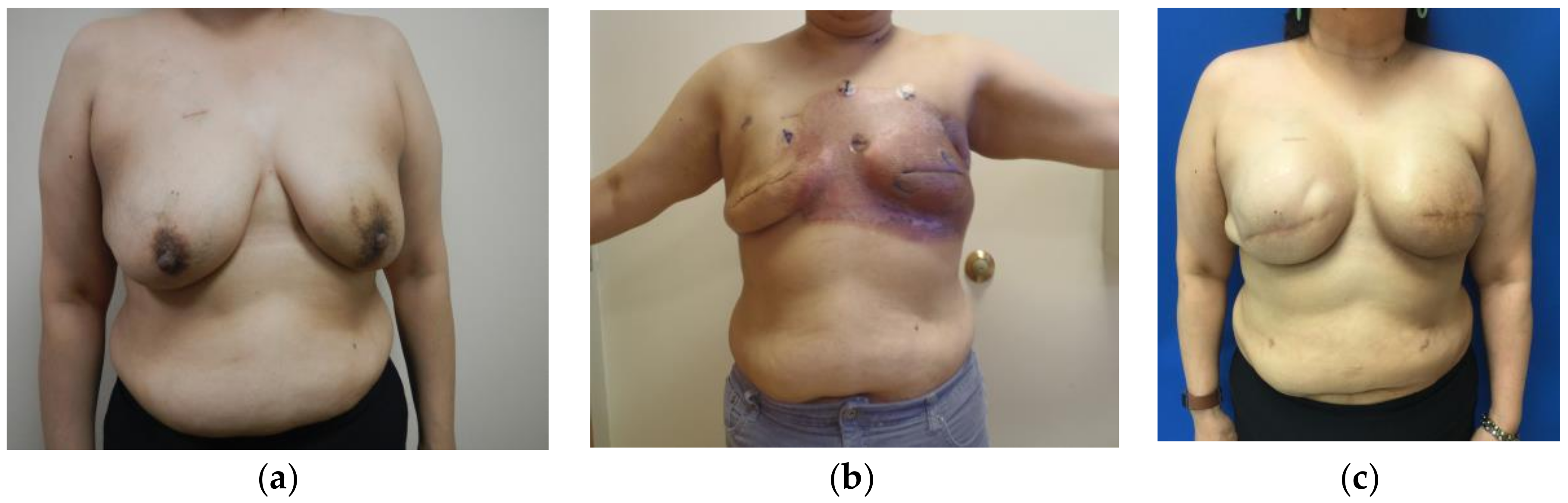 Patient F - Bilateral Breast Reconstruction following Breast