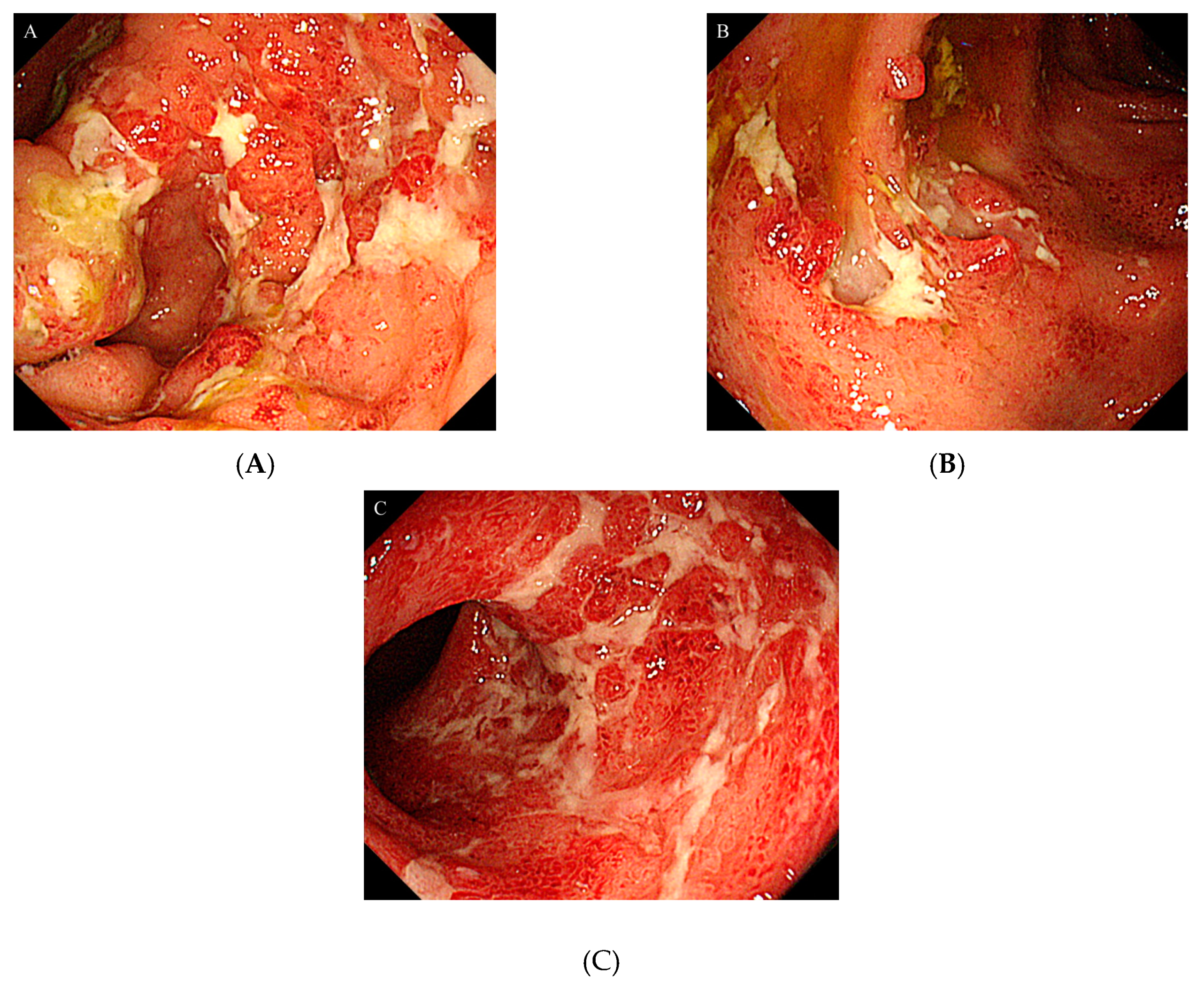 Medicina Free Full Text A Case of Lung Abscess Caused by