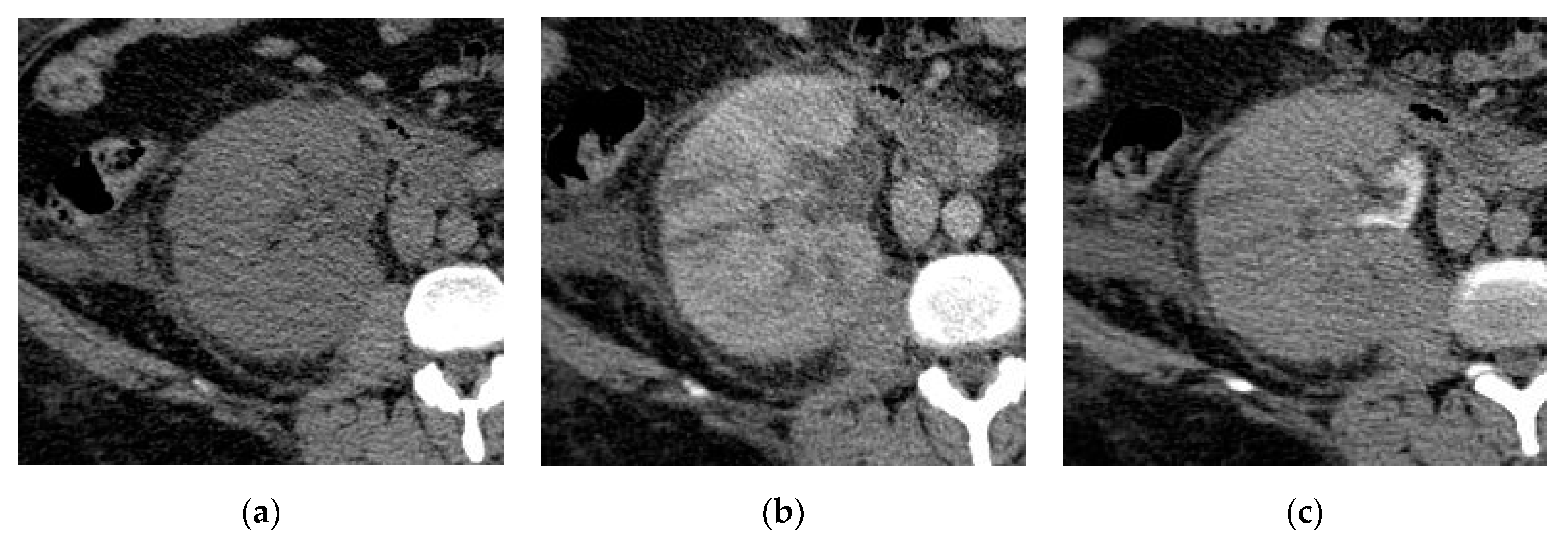 Medicina | Free Full-Text | CT and MRI in Urinary Tract Infections: A  Spectrum of Different Imaging Findings