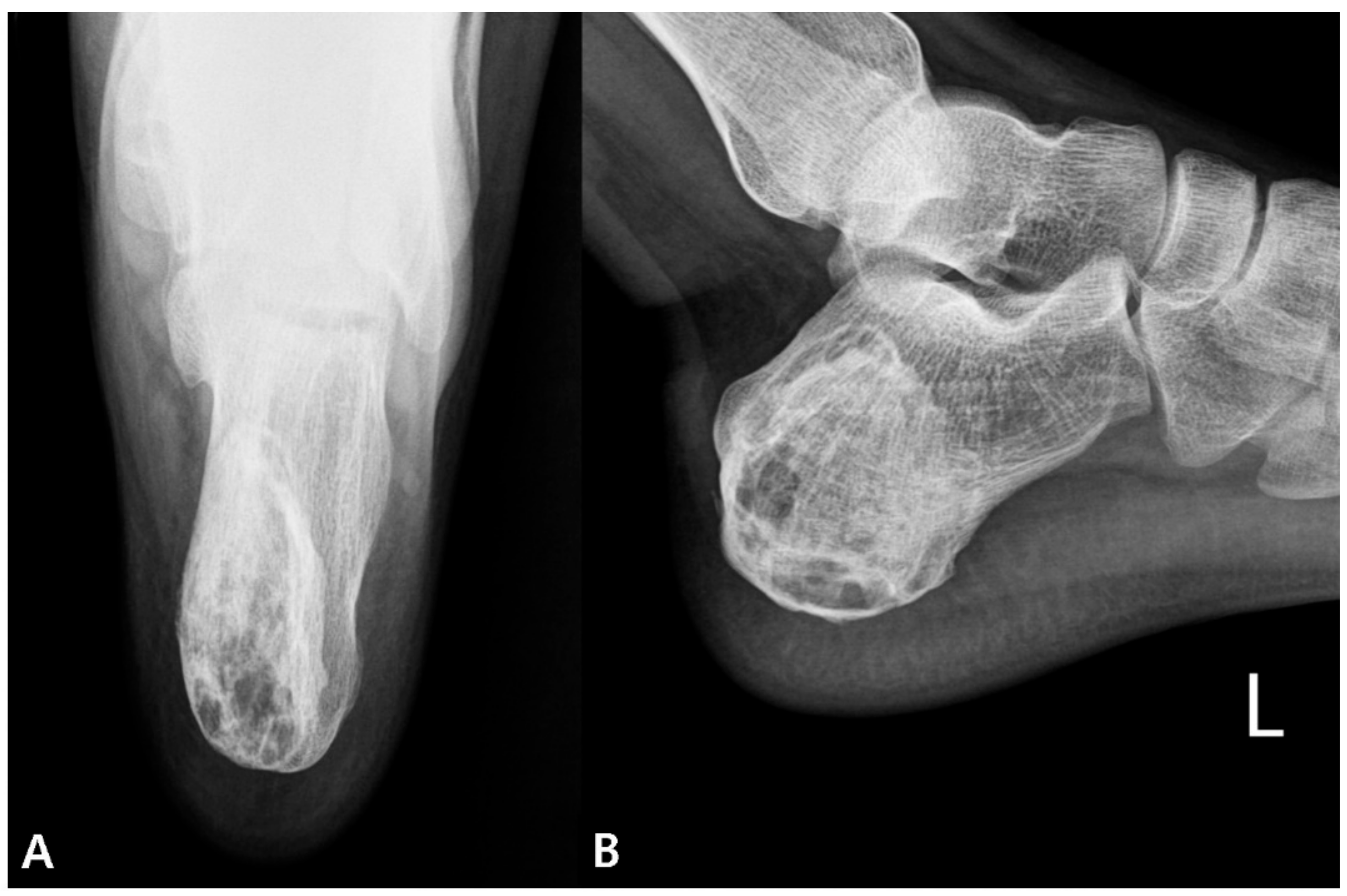 An Unrecognized Foreign Body Retained in the Calcaneus: A Case Report