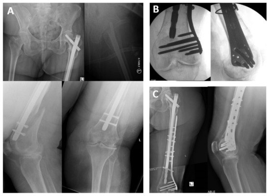 Intraoperative Distal Femoral Fine Wire Traction to Facilitate  Intramedullary Nailing of the Femur | Orthopedics