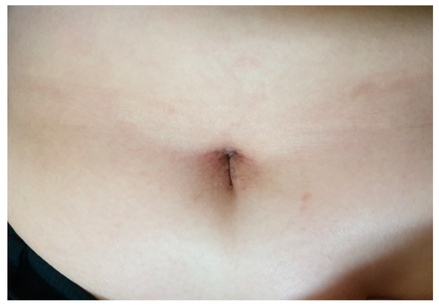 A case series of prophylactic negative pressure wound therapy use with purse -string closure in stoma closure wounds in infants | Surgical Case Reports  | Full Text
