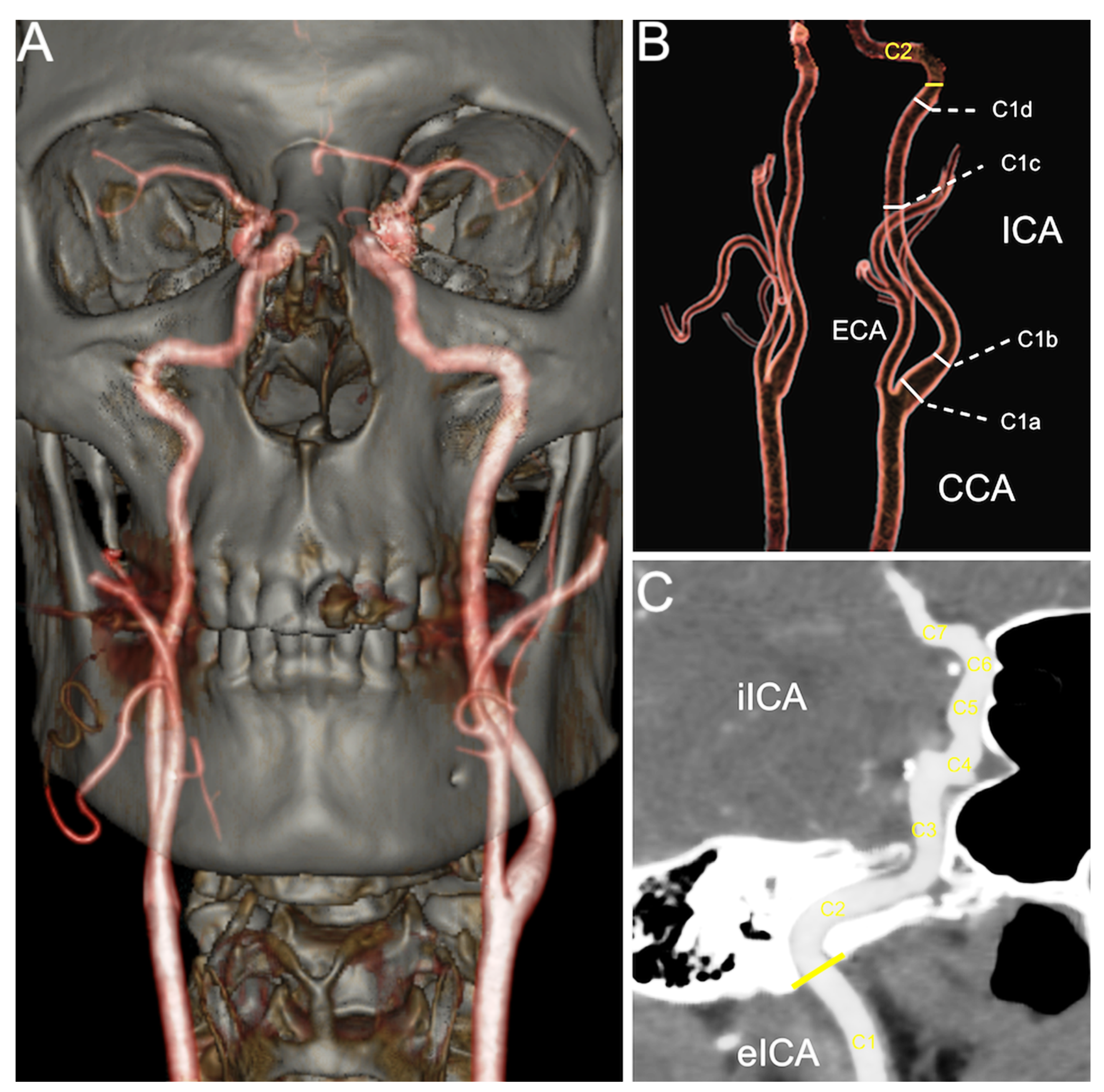 internal carotid artery skull