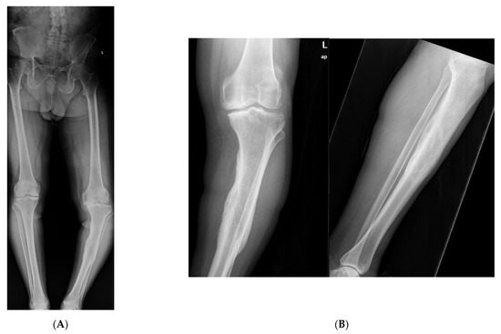 Medicina Special Issue Malunion Of Fractures Of The Lower Extremity