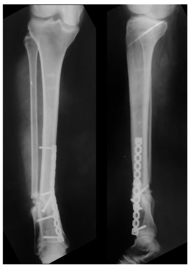 Medicina Special Issue Malunion Of Fractures Of The Lower Extremity