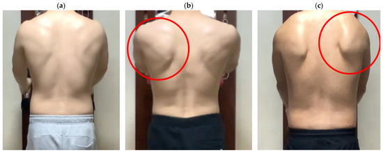 Rounded Shoulders and Shoulder Pain - Lu Strength & Therapy
